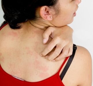 granulómy na tele - príznaky prítomnosti parazitov