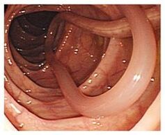 parazitov v ľudskom tele