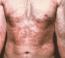 problematická pleť je príznakom prítomnosti parazitov