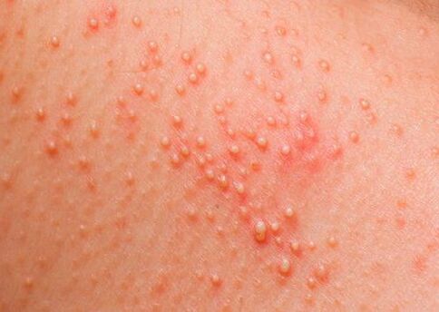 Ak je telo napadnuté parazitmi, objaví sa kožná alergia
