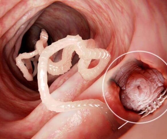 červy v ľudskom čreve foto 2