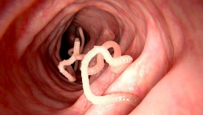 Červy, ktoré žijú v ľudských črevách